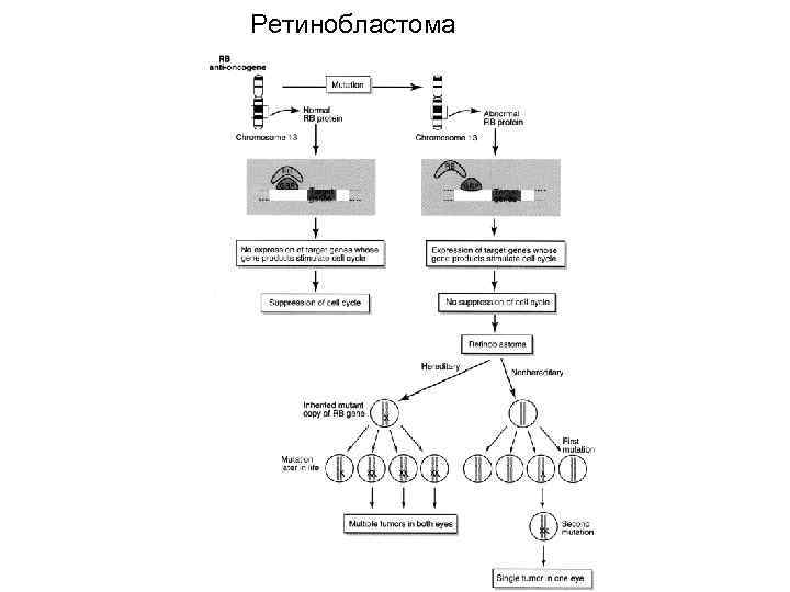 Ретинобластома 