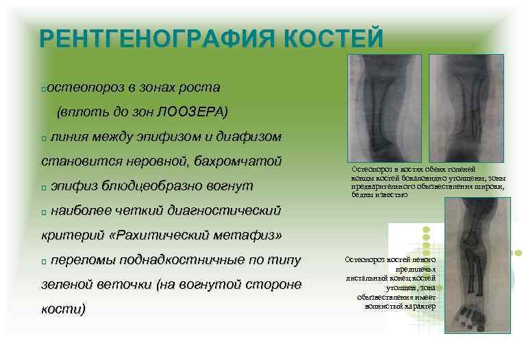 РЕНТГЕНОГРАФИЯ КОСТЕЙ остеопороз в зонах роста (вплоть до зон ЛООЗЕРА) линия между эпифизом и