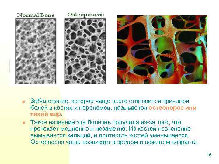 n n Заболевание, которое чаще всего становится причиной болей в костях и переломов, называется