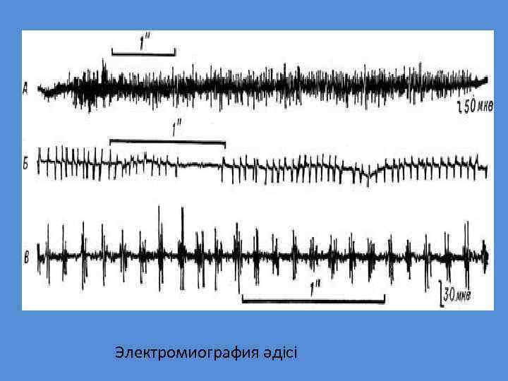 Электромиография әдісі 