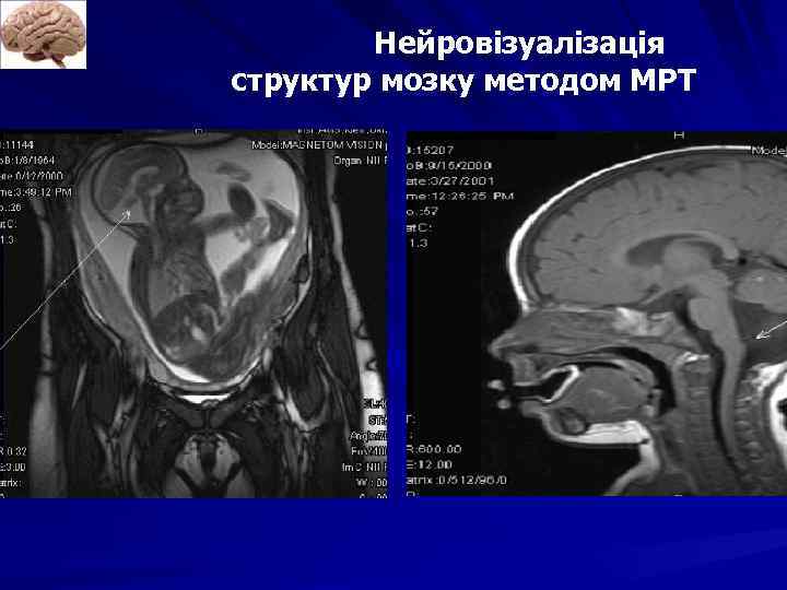 Нейровізуалізація структур мозку методом МРТ 