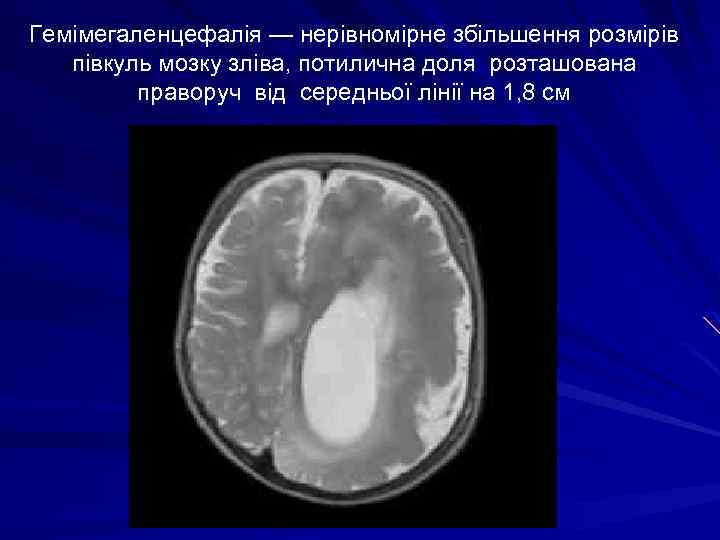 Гемімегаленцефалія — нерівномірне збільшення розмірів півкуль мозку зліва, потилична доля розташована праворуч від середньої