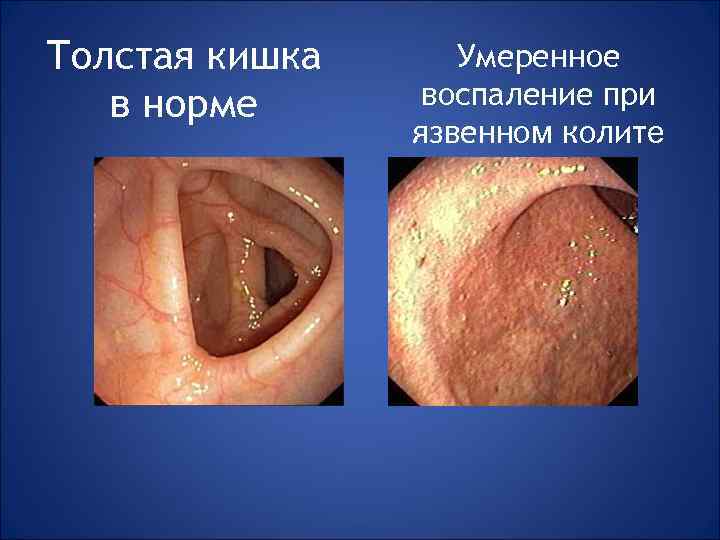 Толстая кишка в норме Умеренное воспаление при язвенном колите 