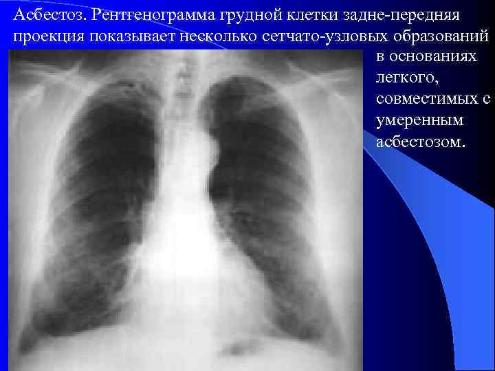 Асбестоз рентгенологическая картина