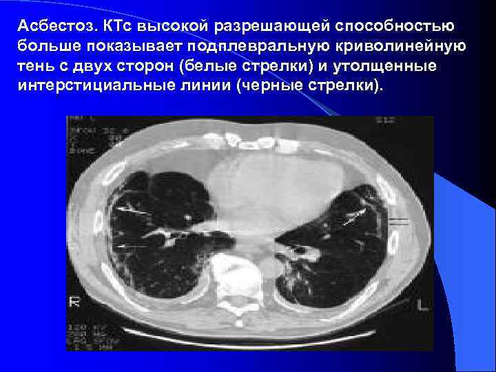 Асбестоз рентгенологическая картина