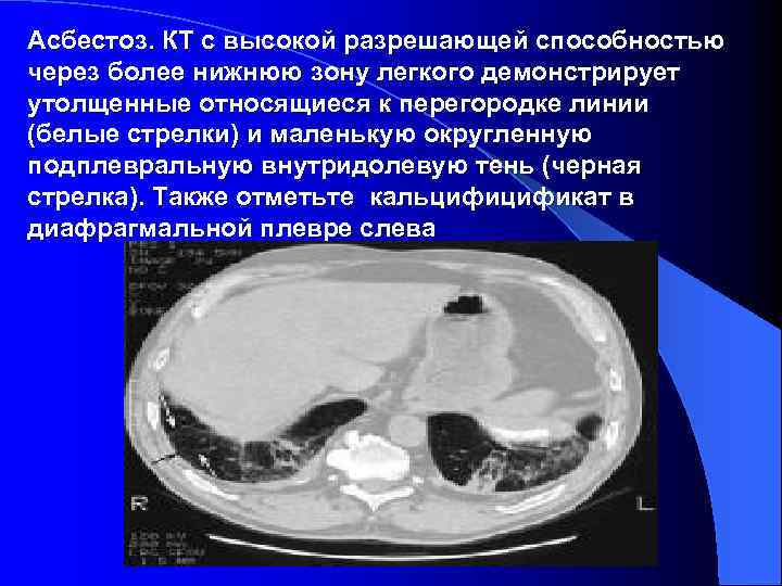Асбестоз. КТ с высокой разрешающей способностью через более нижнюю зону легкого демонстрирует утолщенные относящиеся
