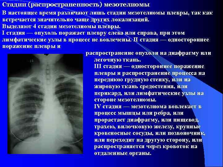 Стадии (распространенность) мезотелиомы В настоящее время различают лишь стадии мезотелиомы плевры, так как встречается