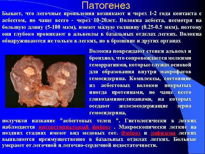 Патогенез Бывает, что легочные проявления возникают и через 1 -2 года контакта с асбестом,