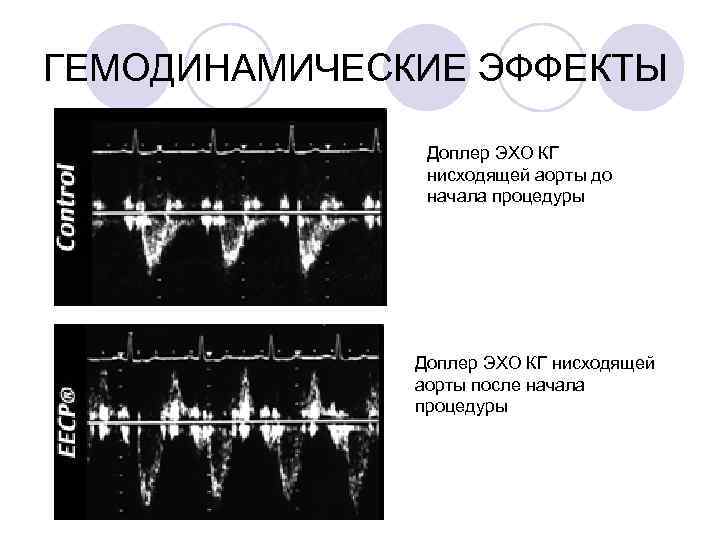 ГЕМОДИНАМИЧЕСКИЕ ЭФФЕКТЫ Доплер ЭХО КГ нисходящей аорты до начала процедуры Доплер ЭХО КГ нисходящей