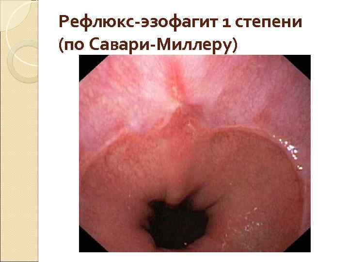 Рефлюкс-эзофагит 1 степени (по Савари-Миллеру) 