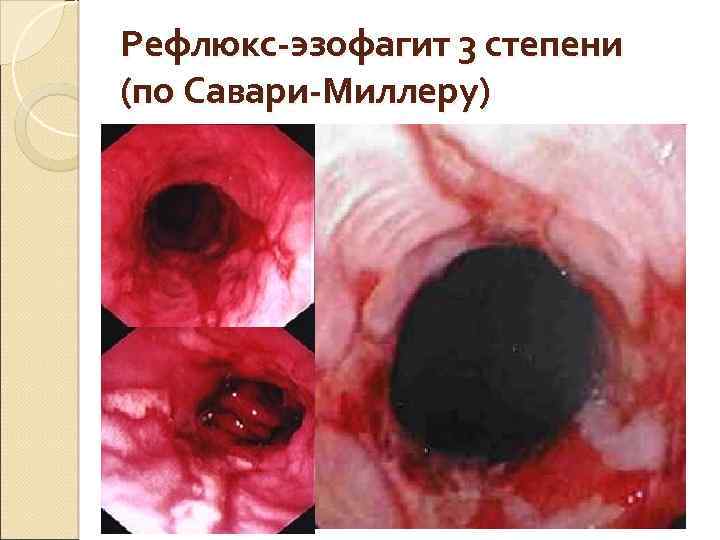 Рефлюкс-эзофагит 3 степени (по Савари-Миллеру) 