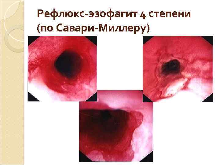 Рефлюкс-эзофагит 4 степени (по Савари-Миллеру) 