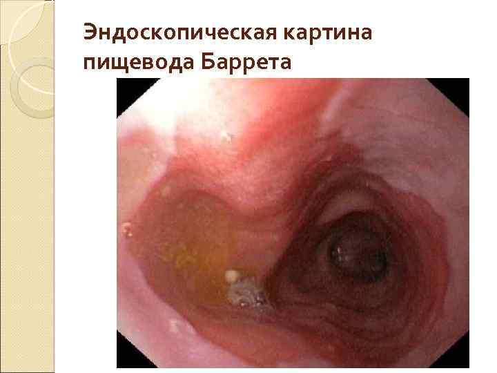 Эндоскопическая картина пищевода Баррета 