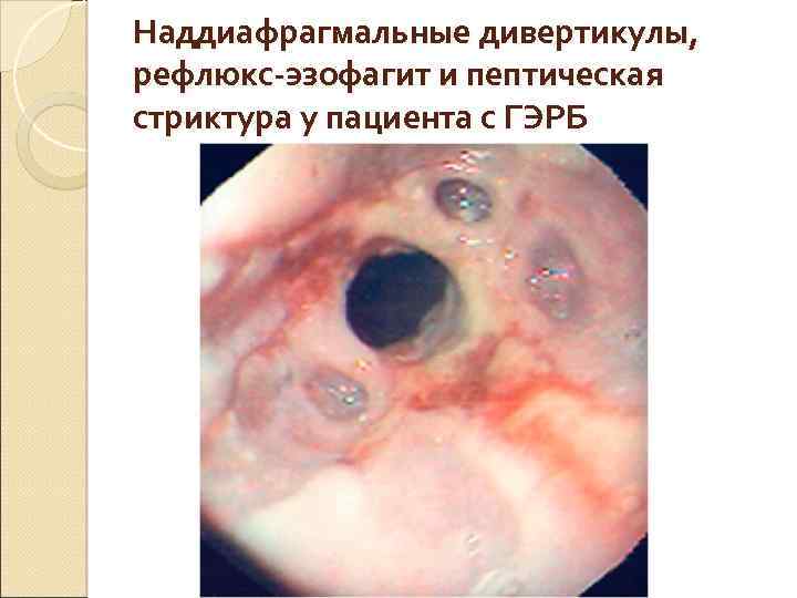 Наддиафрагмальные дивертикулы, рефлюкс-эзофагит и пептическая стриктура у пациента с ГЭРБ 