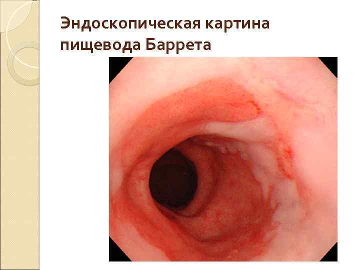 Эндоскопическая картина пищевода Баррета 