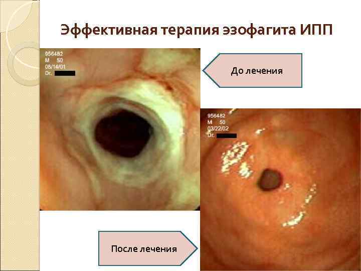 Эффективная терапия эзофагита ИПП До лечения После лечения 