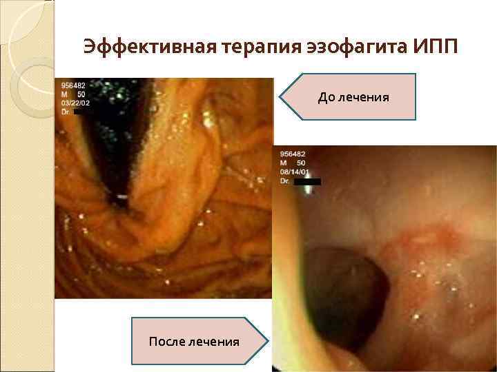 Эффективная терапия эзофагита ИПП До лечения После лечения 