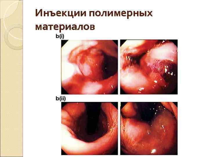 Инъекции полимерных материалов 