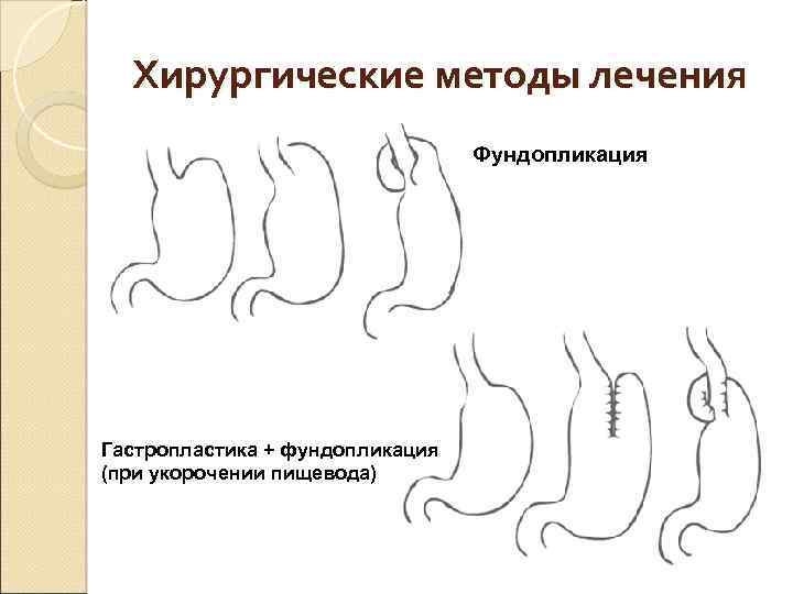 Хирургические методы лечения Фундопликация Гастропластика + фундопликация (при укорочении пищевода) 