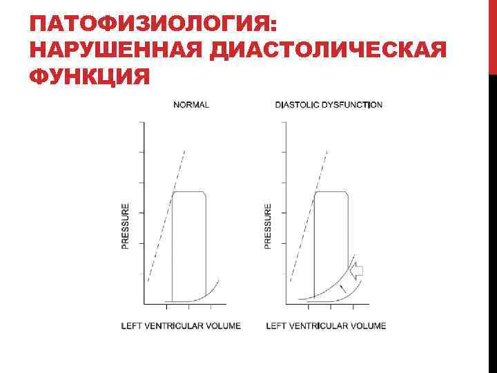 ПАТОФИЗИОЛОГИЯ: НАРУШЕННАЯ ДИАСТОЛИЧЕСКАЯ ФУНКЦИЯ 