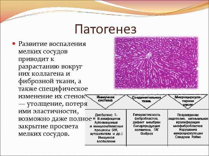 Развитию полной картины системной формы склеродермии предшествуют