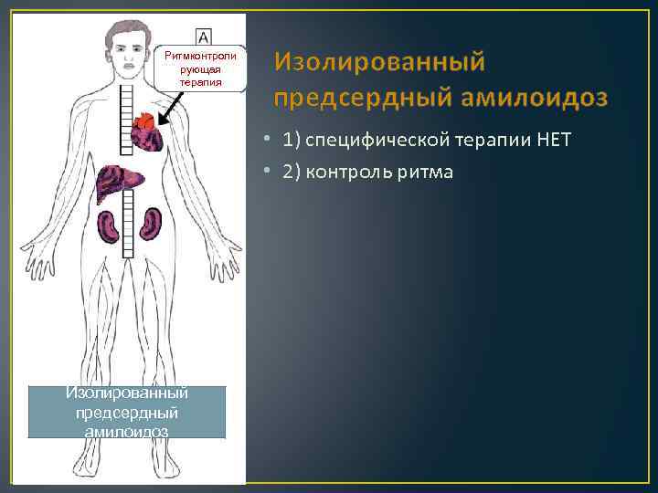 Ритмконтроли рующая терапия Изолированный предсердный амилоидоз • 1) специфической терапии НЕТ • 2) контроль