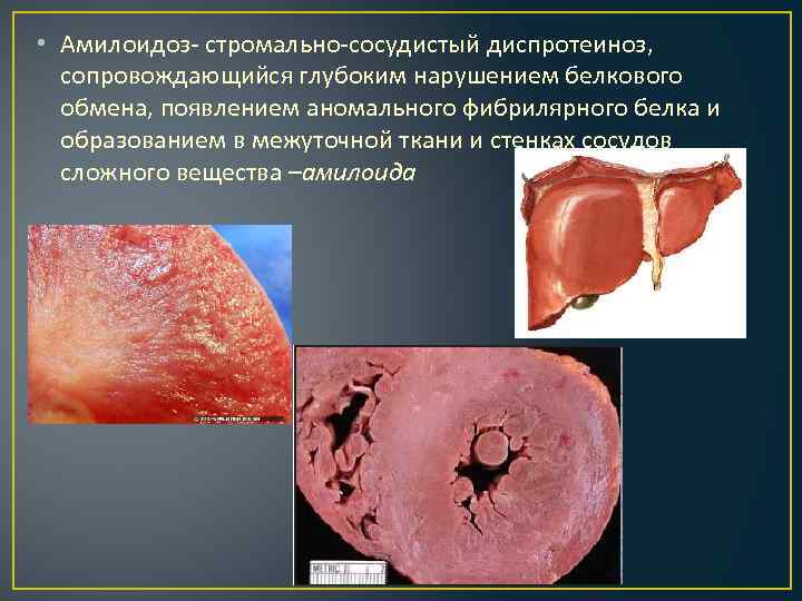  • Амилоидоз- стромально-сосудистый диспротеиноз, сопровождающийся глубоким нарушением белкового обмена, появлением аномального фибрилярного белка