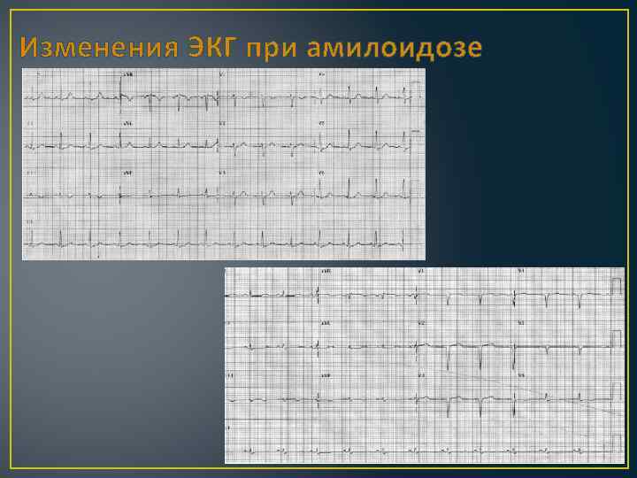 Изменения ЭКГ при амилоидозе 