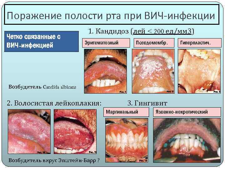 Поражение полости рта при ВИЧ-инфекции Четко связанные с ВИЧ-инфекцией 1. Кандидоз (лей < 200