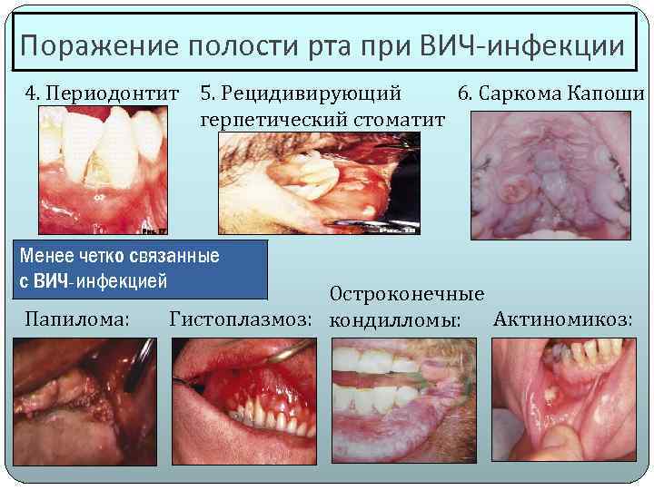 Поражение полости рта при ВИЧ-инфекции 4. Периодонтит 5. Рецидивирующий 6. Саркома Капоши герпетический стоматит