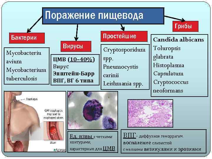 Поражение пищевода Грибы Простейшие Бактерии Mycobacteriu avium Mycobacterium tuberculosis Вирусы ЦМВ (10– 40%) Вирус