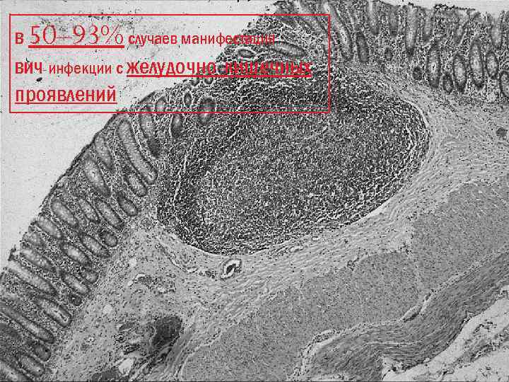 В 50– 93% случаев манифестация ВИЧ-инфекции с желудочно-кишечных проявлений 