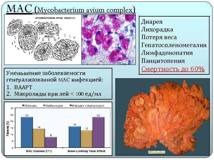 MAC (Mycobacterium avium complex) Диарея Лихорадка Потеря веса Гепатоспленомегалия Лимфаденопатия Панцитопения Уменьшение заболеваемости генерализованной