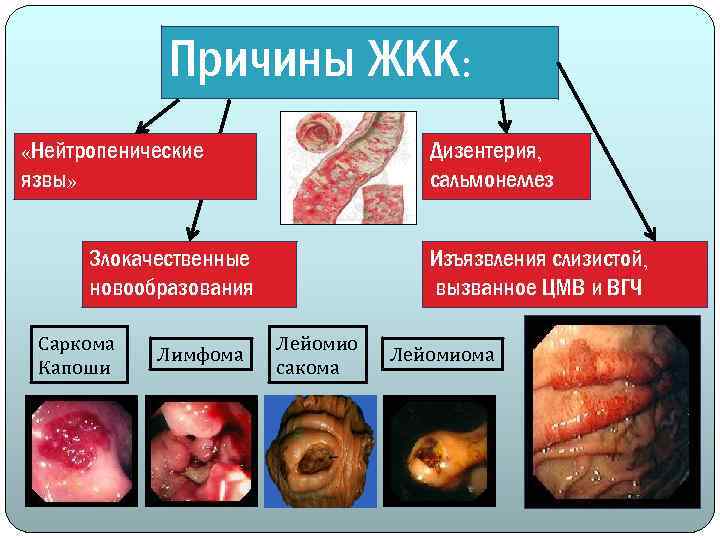 Причины ЖКК: Дизентерия, сальмонеллез «Нейтропенические язвы» Злокачественные новообразования Саркома Капоши Лимфома Изъязвления слизистой, вызванное