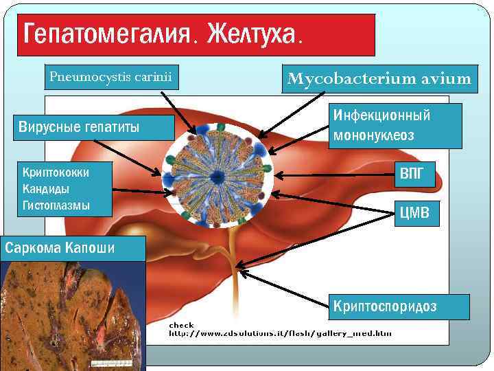 Гепатомегалия. Желтуха. Pneumocystis carinii Вирусные гепатиты Криптококки Кандиды Гистоплазмы Mycobacterium avium Инфекционный мононуклеоз ВПГ