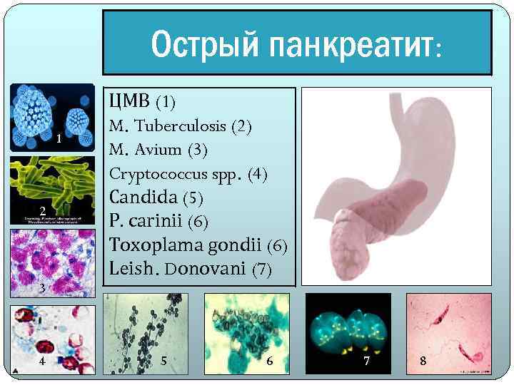 Острый панкреатит: 1 2 3 4 ЦМВ (1) M. Tuberculosis (2) M. Avium (3)