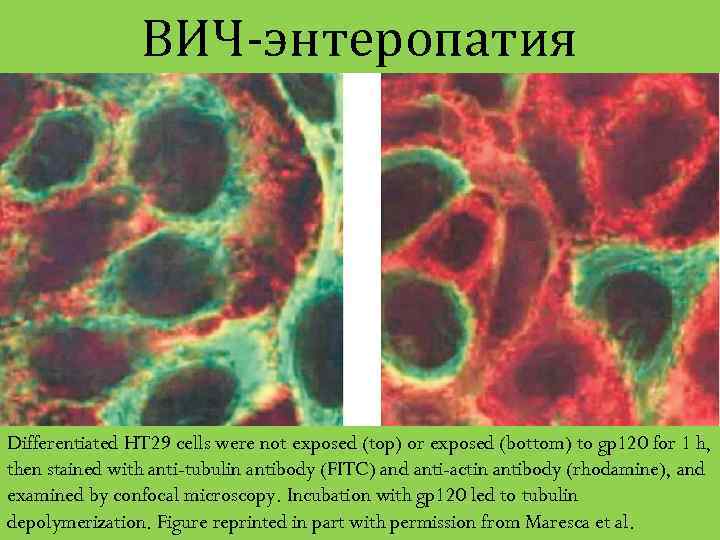 ВИЧ-энтеропатия Differentiated HT 29 cells were not exposed (top) or exposed (bottom) to gp