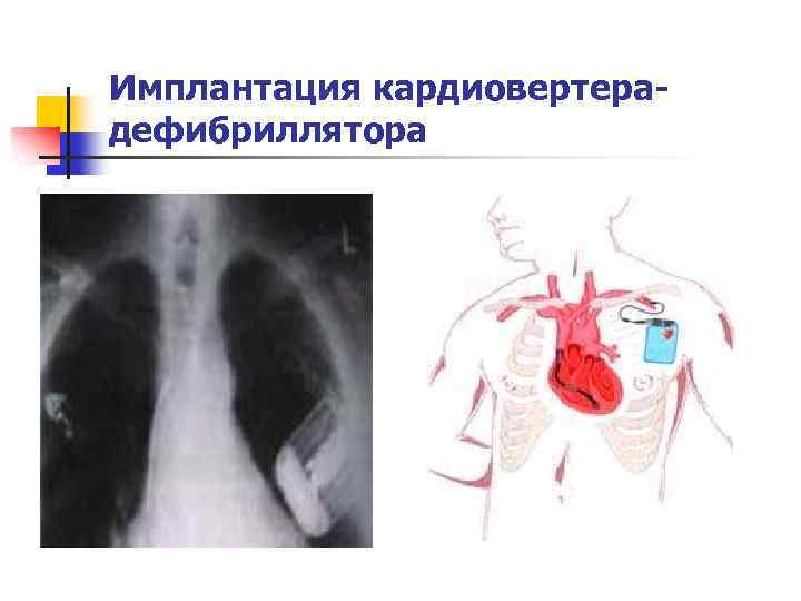 Имплантация кардиовертерадефибриллятора 