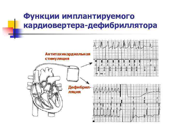 Принципиальная схема дефибриллятора