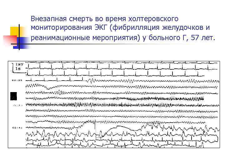 Внезапная смерть во время холтеровского мониторирования ЭКГ (фибрилляция желудочков и реанимационные мероприятия) у больного