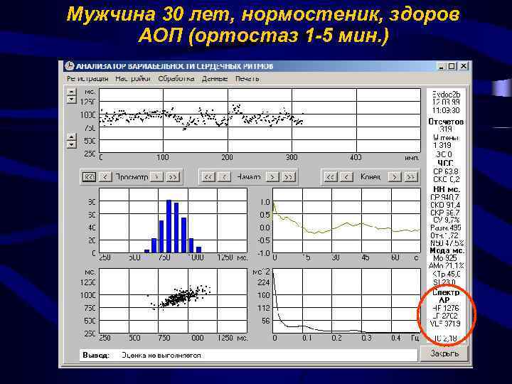 Мужчина 30 лет, нормостеник, здоров АОП (ортостаз 1 -5 мин. ) 