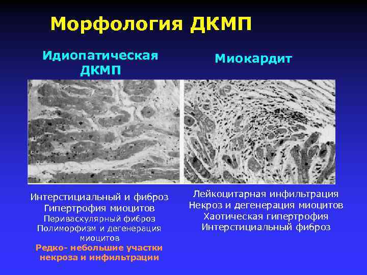 Морфология ДКМП Идиопатическая ДКМП Интерстициальный и фиброз Гипертрофия миоцитов Периваскулярный фиброз Полиморфизм и дегенерация