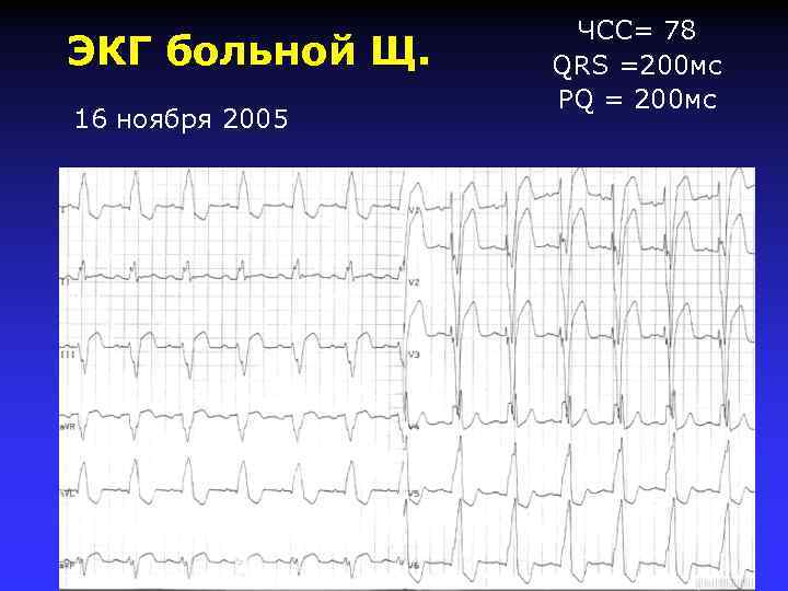 ЭКГ больной Щ. 16 ноября 2005 ЧСС= 78 QRS =200 мс PQ = 200