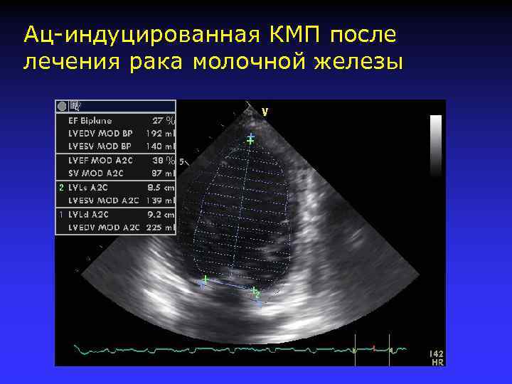 Ац-индуцированная КМП после лечения рака молочной железы 