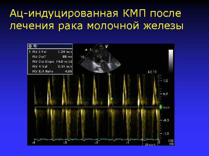 Ац-индуцированная КМП после лечения рака молочной железы 