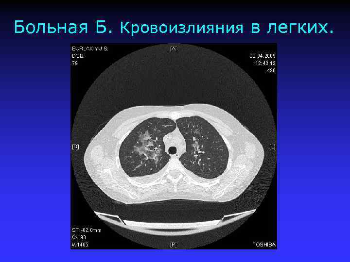 Больная Б. Кровоизлияния в легких. 