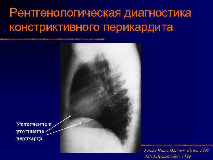 Рентгенологическая диагностика констриктивного перикардита Уплотнение и утолщение перикарда From: Heart Disease 5 th ed.