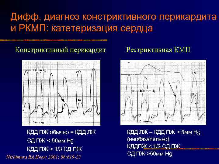 Дифф. диагноз констриктивного перикардита и РКМП: катетеризация сердца Констриктивный перикардит КДД ПЖ обычно =