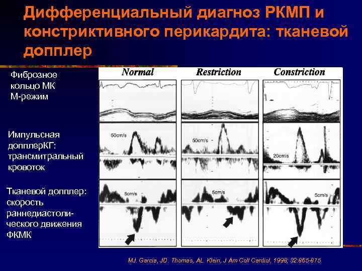 Дифференциальный диагноз РКМП и констриктивного перикардита: тканевой допплер Фиброзное кольцо МК М-режим Импульсная допплер.