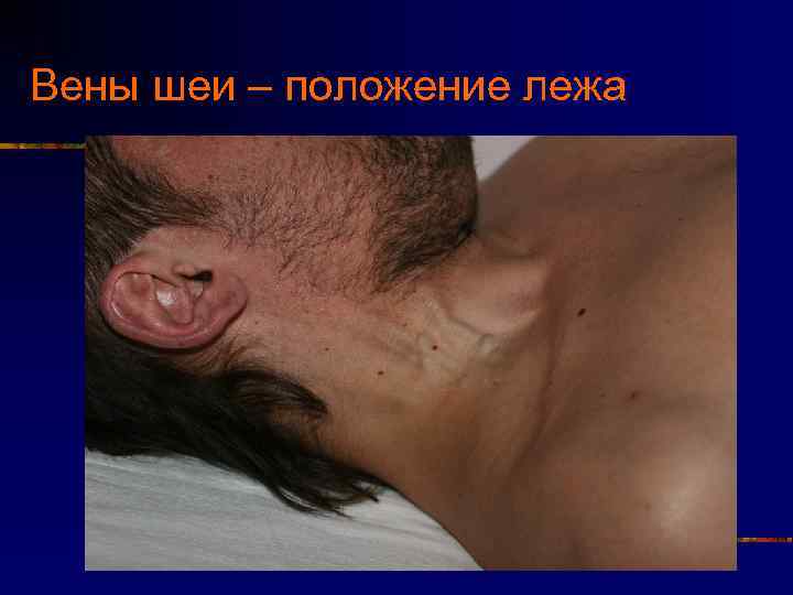 Вены шеи – положение лежа 
